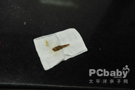 "囫囵吞枣"整条鸡骨头卡入肛门