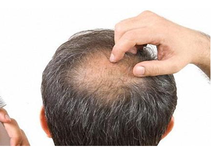 男性头顶脱发是什么原因?有关男性头顶脱发治疗