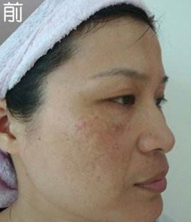 脸上有黄褐斑怎么治疗,揭秘治黄褐斑的有效方法