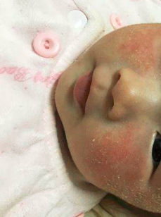 新生儿脸上起些湿疹,轻松搞定的日常小护理