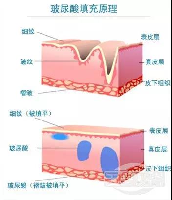 玻尿酸,又称透明质酸,是人体的一种物质,透明质酸以其独特的分子