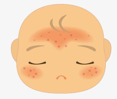 婴儿湿疹时都有哪些表现?