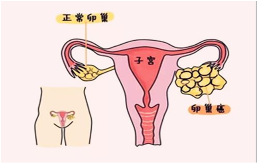 卵巢癌人口_卵巢癌肚子大的图片