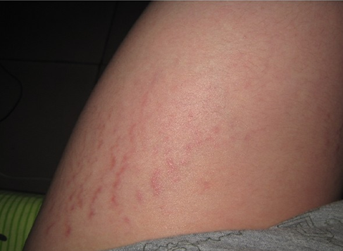 腿上的橘皮纹怎么去掉 塑造完美身姿