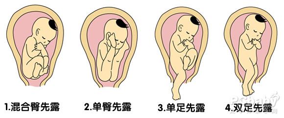 单臀先露胎儿图图片